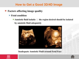 Factors affecting image quality
Fetal condition
Amniotic fluid isolatio ： the region desired should be isolated
by amniotic fluid adequately
How to Get a Good 3D/4D Image
Inadequate Amniotic Fluid around Fetal Face
 