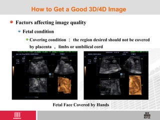 Factors affecting image quality
Fetal condition
Covering condition ： the region desired should not be covered
by placenta ， limbs or umbilical cord
How to Get a Good 3D/4D Image
Fetal Face Covered by Hands
 