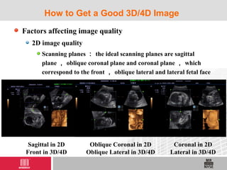 Factors affecting image quality
2D image quality
Scanning planes ： the ideal scanning planes are sagittal
plane ， oblique coronal plane and coronal plane ， which
correspond to the front ， oblique lateral and lateral fetal face
How to Get a Good 3D/4D Image
Sagittal in 2D
Front in 3D/4D
Oblique Coronal in 2D
Oblique Lateral in 3D/4D
Coronal in 2D
Lateral in 3D/4D
 