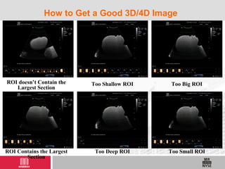 How to Get a Good 3D/4D Image
ROI doesn’t Contain the
Largest Section
ROI Contains the Largest
Section
Too Shallow ROI
Too Deep ROI
Too Big ROI
Too Small ROI
 