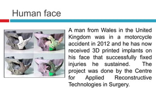 Human face
A man from Wales in the United
Kingdom was in a motorcycle
accident in 2012 and he has now
received 3D printed implants on
his face that successfully fixed
injuries he sustained. The
project was done by the Centre
for Applied Reconstructive
Technologies in Surgery.
 