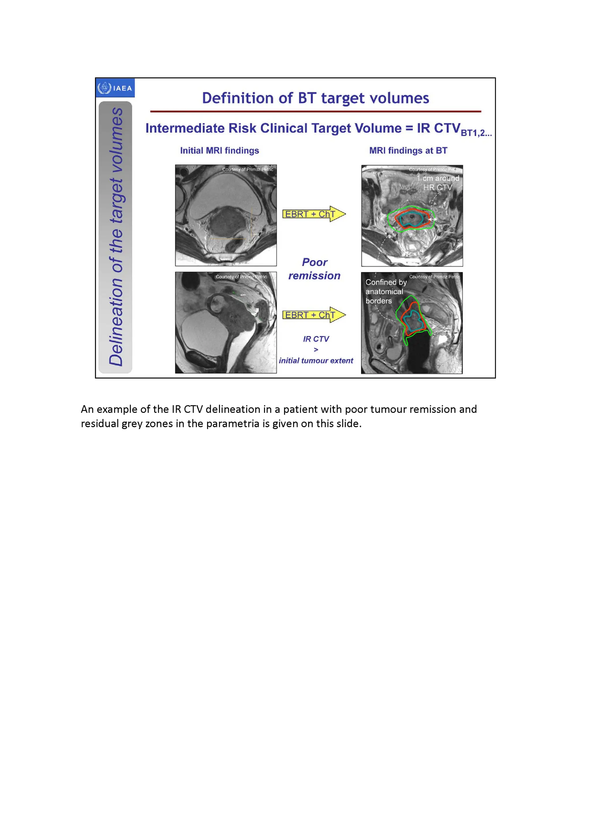 3D brachytherapy - definition and delineation of the target volumes ...