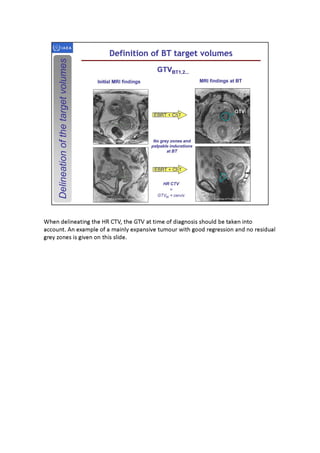 3D brachytherapy - definition and delineation of the target volumes ...