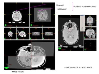 MRI IMAGE
CT IMAGE
CONTOURING ON BLENDED IMAGE
POINT TO POINT MATCHING
IMAGE FUSION
 