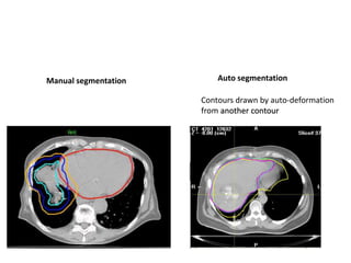 Manual segmentation Auto segmentation
Contours drawn by auto-deformation
from another contour
 