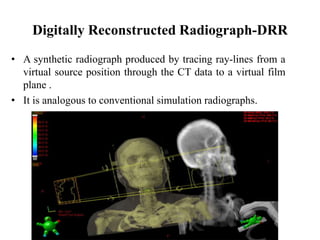Digitally Reconstructed Radiograph-DRR
• A synthetic radiograph produced by tracing ray-lines from a
virtual source position through the CT data to a virtual film
plane .
• It is analogous to conventional simulation radiographs.
 