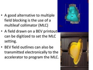 • A good alternative to multiple
field blocking is the use of a
multileaf collimator (MLC)
• A field drawn on a BEV printout
can be digitized to set the MLC
setting.
• BEV field outlines can also be
transmitted electronically to the
accelerator to program the MLC.
 
