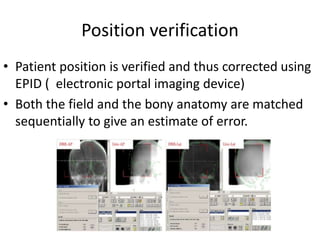 Position verification
• Patient position is verified and thus corrected using
EPID ( electronic portal imaging device)
• Both the field and the bony anatomy are matched
sequentially to give an estimate of error.
 