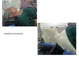 -Anaplastic astrocytoma
-
 