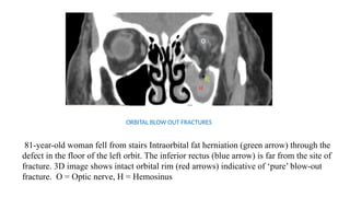 Comprehensive CT Imaging and Anatomy of Facial Fractures and Injuries ...