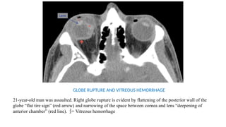 Globe Rupture Memory Note Comprehensive CT Imaging and Anatomy of Facial Fractures and Injuries ...