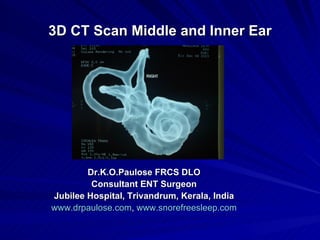 3D CT Scan Middle and Inner Ear




        Dr.K.O.Paulose FRCS DLO
         Consultant ENT Surgeon
Jubilee Hospital, Trivandrum, Kerala, India
www.drpaulose.com, www.snorefreesleep.com
 