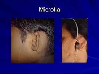 Microcus Ear 3D CT Middle and Inner Ear | PPT
