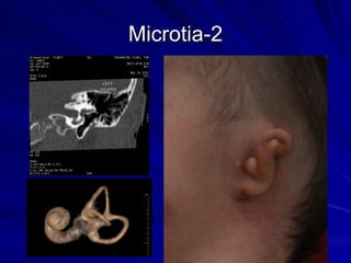 Microcus Ear 3D CT Middle and Inner Ear | PPT