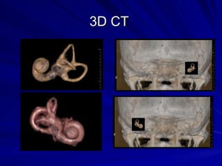 3D CT Middle and Inner Ear | PPT