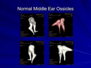 3D CT Middle and Inner Ear | PPT