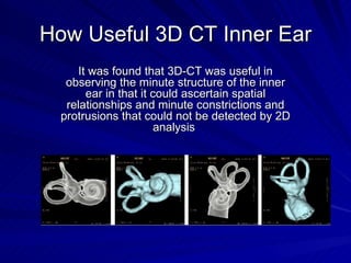 How Useful 3D CT Inner Ear
     It was found that 3D-CT was useful in
   observing the minute structure of the inner
     ...