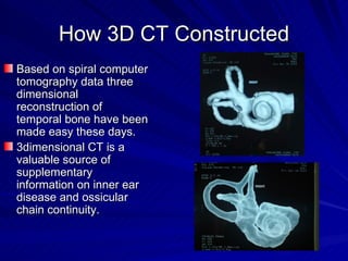 How 3D CT Constructed
Based on spiral computer
tomography data three
dimensional
reconstruction of
temporal bone have been...