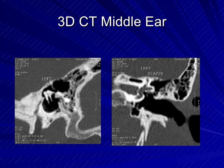 3D CT Middle and Inner Ear
