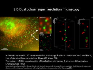 3 D Dual colour  super resolution microscopy In breast cancer cells: 3D super resolution microscopy & cluster  analysis of Her2 and Her3 ,  Use of standard fluorescent dyes: Alexa 488, Alexa 568 Technology: LIMON = combination of localization microscopy & structured illumination:  SPDMphymod + SMI  Rainer Kaufmann, Patrick Müller, Georg Hildenbrand, Michael Hausmann & Christoph Cremer: Analysis of Her2/neu membrane protein  clusters in different types of breast cancer cells using localization microscopy, Journal of Microscopy 2010 