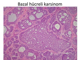 Bazal hücreli karsinom
 