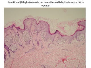 Junctional (bileşke) nevusta dermaepidermal bileşkede nevus hücre
yuvaları
 