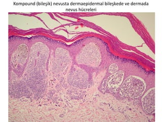 Kompound (bileşik) nevusta dermaepidermal bileşkede ve dermada
nevus hücreleri
 