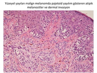 Yüzeyel yayılan malign melanomda pajetoid yayılım gösteren atipik
melanositler ve dermal invazyon
 