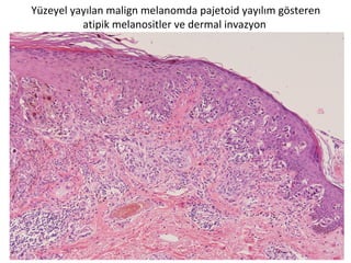 Yüzeyel yayılan malign melanomda pajetoid yayılım gösteren
atipik melanositler ve dermal invazyon
 