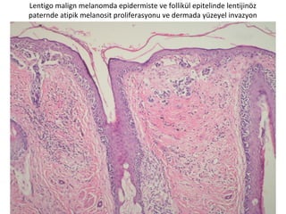 Lentigo malign melanomda epidermiste ve follikül epitelinde lentijinöz
paternde atipik melanosit proliferasyonu ve dermada yüzeyel invazyon
 
