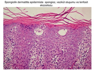 Spongiotik dermatitte epidermiste spongioz, vezikül oluşumu ve lenfosit
ekzositozu
 