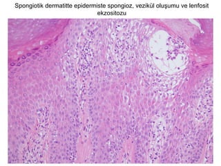 Spongiotik dermatitte epidermiste spongioz, vezikül oluşumu ve lenfosit
ekzositozu
 