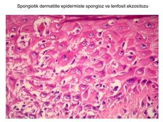 Spongiotik dermatitte epidermiste spongioz ve lenfosit ekzositozu
 