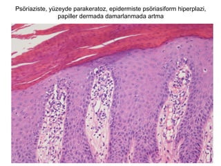 Psöriaziste, yüzeyde parakeratoz, epidermiste psöriasiform hiperplazi,
papiller dermada damarlanmada artma
 