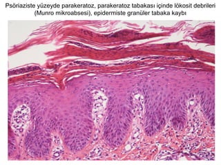 Psöriaziste yüzeyde parakeratoz, parakeratoz tabakası içinde lökosit debrileri
(Munro mikroabsesi), epidermiste granüler tabaka kaybı
 