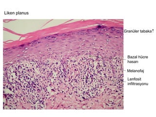 Granüler tabaka
Bazal hücre
hasarı
Lenfosit
infiltrasyonu
Liken planus
Melanofaj
 
