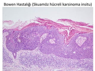 Bowen Hastalığı (Skuamöz hücreli karsinoma insitu)
 