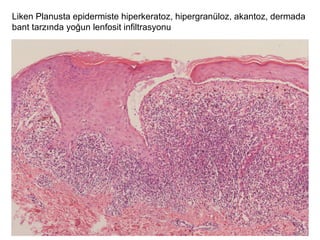 Liken Planusta epidermiste hiperkeratoz, hipergranüloz, akantoz, dermada
bant tarzında yoğun lenfosit infiltrasyonu
 