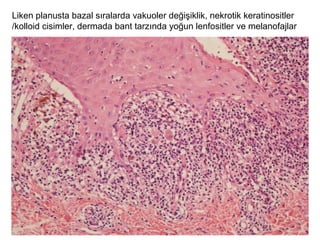 Liken planusta bazal sıralarda vakuoler değişiklik, nekrotik keratinositler
/kolloid cisimler, dermada bant tarzında yoğun lenfositler ve melanofajlar
 