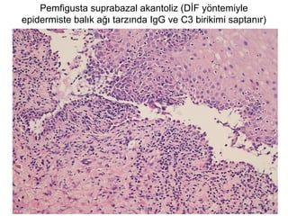 Pemfigusta suprabazal akantoliz (DİF yöntemiyle
epidermiste balık ağı tarzında IgG ve C3 birikimi saptanır)
 