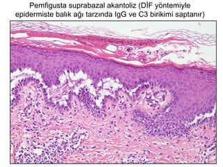 Pemfigusta suprabazal akantoliz (DİF yöntemiyle
epidermiste balık ağı tarzında IgG ve C3 birikimi saptanır)
 
