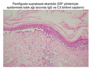 Pemfigusta suprabazal akantoliz (DİF yöntemiyle
epidermiste balık ağı tarzında IgG ve C3 birikimi saptanır)
 