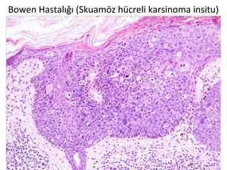 Bowen Hastalığı (Skuamöz hücreli karsinoma insitu)
 