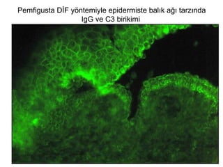 Pemfigusta DİF yöntemiyle epidermiste balık ağı tarzında
IgG ve C3 birikimi
 
