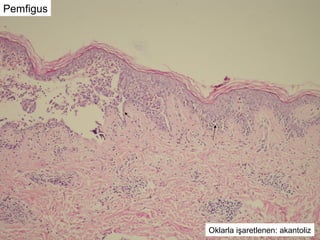 Pemfigus
Oklarla işaretlenen: akantoliz
 
