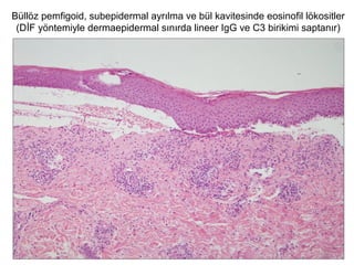 Büllöz pemfigoid, subepidermal ayrılma ve bül kavitesinde eosinofil lökositler
(DİF yöntemiyle dermaepidermal sınırda lineer IgG ve C3 birikimi saptanır)
 