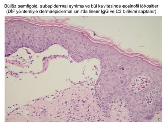 Büllöz pemfigoid, subepidermal ayrılma ve bül kavitesinde eosinofil lökositler
(DİF yöntemiyle dermaepidermal sınırda lineer IgG ve C3 birikimi saptanır)
 