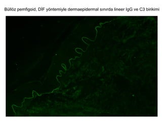 Büllöz pemfigoid, DİF yöntemiyle dermaepidermal sınırda lineer IgG ve C3 birikimi
 