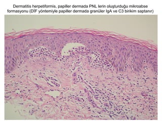 Dermatitis herpetiformis, papiller dermada PNL lerin oluşturduğu mikroabse
formasyonu (DİF yöntemiyle papiller dermada granüler IgA ve C3 birikim saptanır)
 