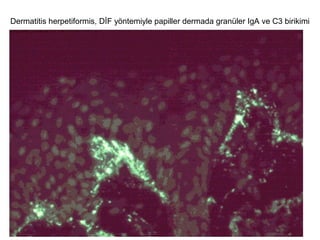 Dermatitis herpetiformis, DİF yöntemiyle papiller dermada granüler IgA ve C3 birikimi
 